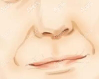 鼻唇溝也叫法令紋 鼻唇溝也叫法令紋