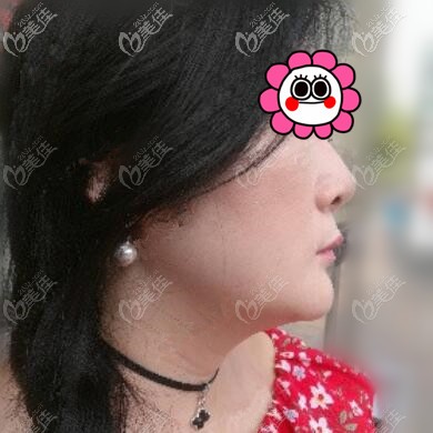 下頜緣吸脂術前照 下頜緣吸脂術前照