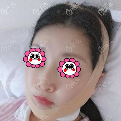 下頜緣吸脂術后當天 下頜緣吸脂術后當天