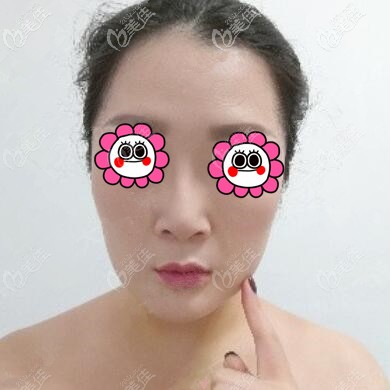 下頜緣吸脂術后6天效果 下頜緣吸脂術后6天效果