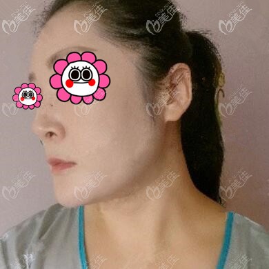 下頜緣吸脂術后20天效果照 下頜緣吸脂術后20天效果照
