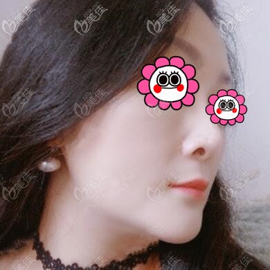 雙下巴吸脂術后32天效果照 雙下巴吸脂術后32天效果照