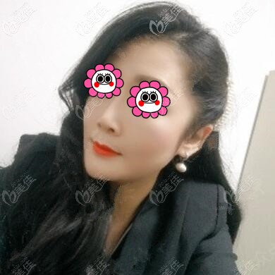 這是我在長沙星雅做下頜緣吸脂3個月的恢復(fù)日記，來看下效果還不錯吧！