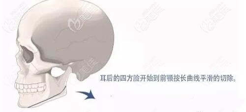 長曲線下頜角手術(shù)的部位 長曲線下頜角手術(shù)的部位