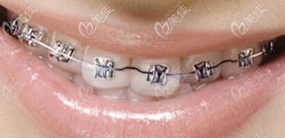 直絲弓矯正技術(shù) 直絲弓矯正技術(shù)