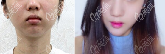 自體脂肪填充下巴30天和術(shù)前的對比圖片 自體脂肪填充下巴30天和術(shù)前的對比圖片