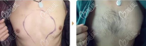 胸毛種植前后效果對比 胸毛種植前后效果對比