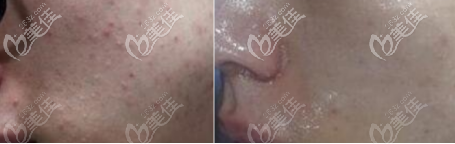 點(diǎn)陣激光祛坑術(shù)前術(shù)后對(duì)比照 點(diǎn)陣激光祛坑術(shù)前術(shù)后對(duì)比照