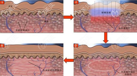 深藍(lán)射頻治療原理 深藍(lán)射頻治療原理