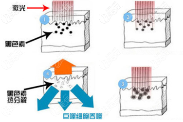 c8激光祛斑過程示意圖 c8激光祛斑過程示意圖