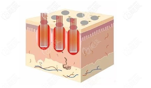 點(diǎn)陣激光治療原理 點(diǎn)陣激光治療原理