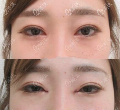 大連愛(ài)得麗格劉志剛內(nèi)眼角修復(fù)成功案例