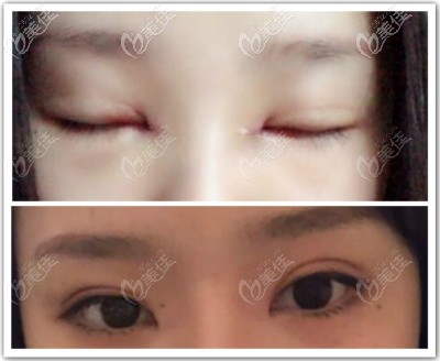 大連愛(ài)得麗格劉志剛眼角修復(fù)好案例圖片