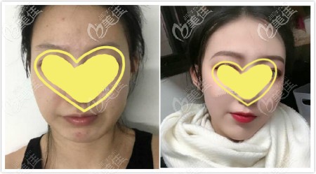 下頜角切除+劈外板截骨真人案例效果圖 下頜角切除+劈外板截骨真人案例效果圖