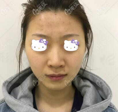 皮秒提亮膚色術(shù)前照 皮秒提亮膚色術(shù)前照