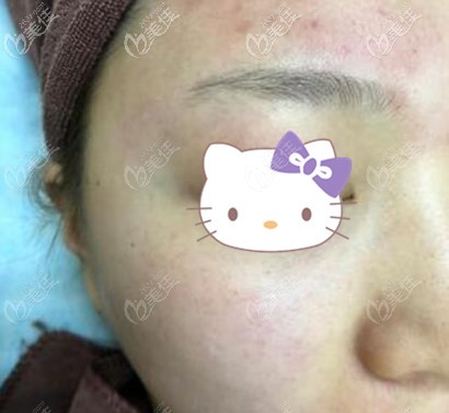 皮秒祛黃提亮膚色術(shù)后即刻效果照 皮秒祛黃提亮膚色術(shù)后即刻效果照