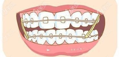 剛開始戴牙套會(huì)有不適應(yīng)