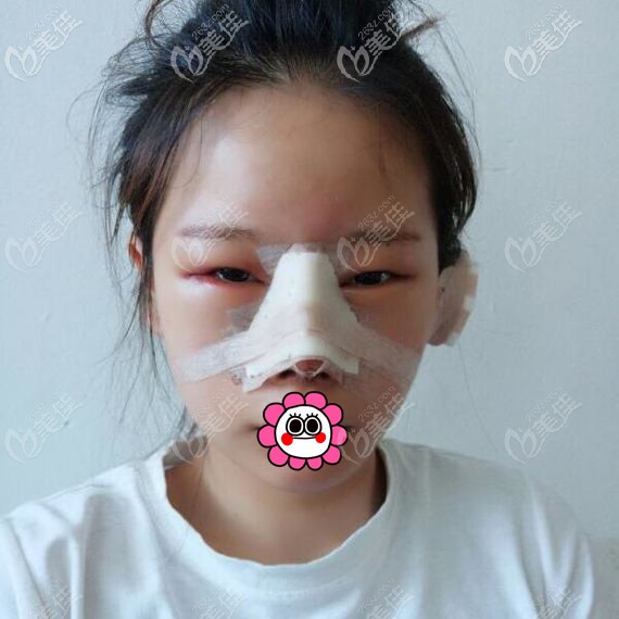 杭州瑞麗蹇洪肋軟骨隆鼻后