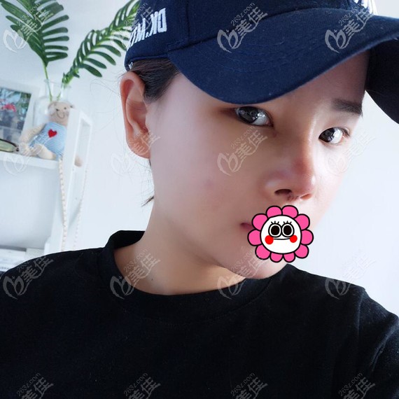 半肋骨隆鼻術(shù)后7天拆線