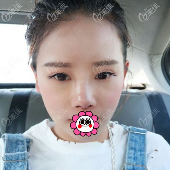 半肋骨鼻整形恢復(fù)半個月效果