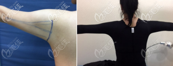 手臂吸脂術前術后對比照片 手臂吸脂術前術后對比照片