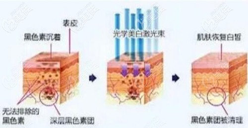 彩光嫩膚的原理 彩光嫩膚的原理