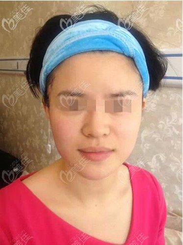 彩光嫩膚右邊臉治療對比效果 彩光嫩膚右邊臉治療對比效果