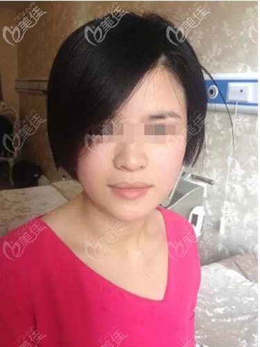 彩光嫩膚兩邊臉治療后效果 彩光嫩膚兩邊臉治療后效果