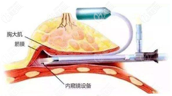內(nèi)窺鏡隆胸 內(nèi)窺鏡隆胸