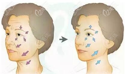 微創(chuàng)面部除皺效果前后對(duì)比照 微創(chuàng)面部除皺效果前后對(duì)比照