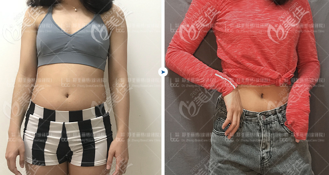 重慶鄭荃麗格A4體雕機(jī)瘦腰腹效果