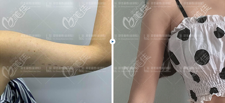 重慶5G天使光雕手臂吸脂效果