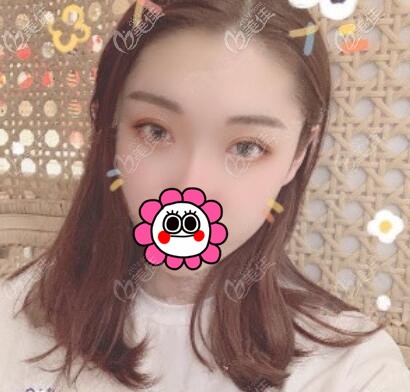 想知道微創(chuàng)埋線雙眼皮效果好不好？來(lái)看我術(shù)后30天的恢復(fù)效果圖就知道了！