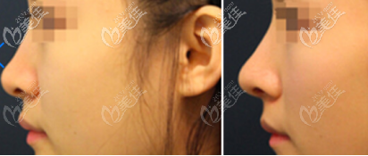 玻尿酸隆鼻前后一個(gè)月的對(duì)比照片