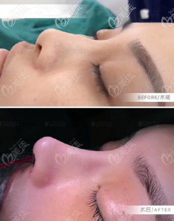 貴州利美康復(fù)合隆鼻效果 貴州利美康復(fù)合隆鼻效果