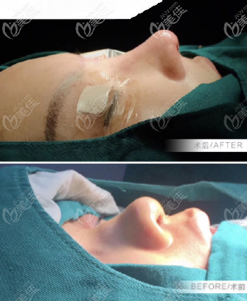 <!--<i data=20240703-sp></i>-->膨體+半肋鼻綜合案例 <!--<i data=20240703-sp></i>-->膨體+半肋鼻綜合案例