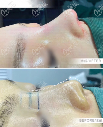 拿到幾張膨體+半肋鼻綜合照片和價(jià)格表，個(gè)人認(rèn)為效果值98000+