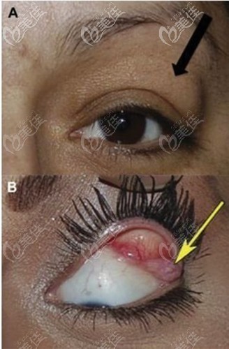 淚腺脫垂癥狀圖片