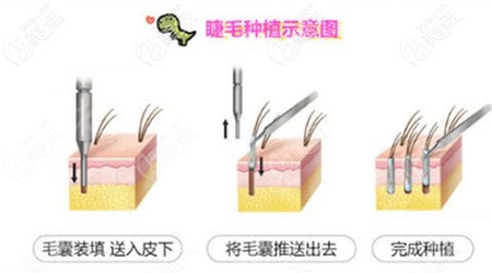 睫毛種植過程示意圖 睫毛種植過程示意圖