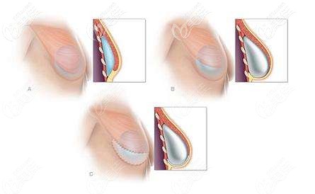 隆胸假體置放的位置 隆胸假體置放的位置