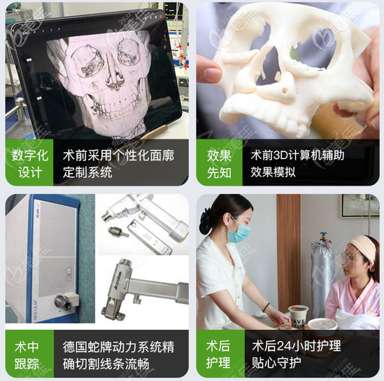 下頜角磨骨手術(shù)過程 下頜角磨骨手術(shù)過程