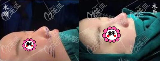 北京華韓王義山院長鼻綜合真人案例