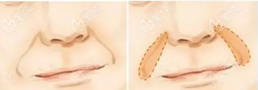 法令紋的部位 法令紋的部位