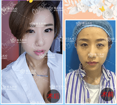 北京彤美做雙眼皮怎么樣？劉風(fēng)卓切開雙眼案例效果參考