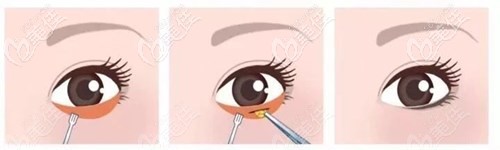 去眼袋手術(shù)過程