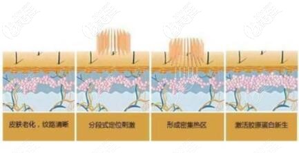 點陣激光治療黑頭的原理 點陣激光治療黑頭的原理