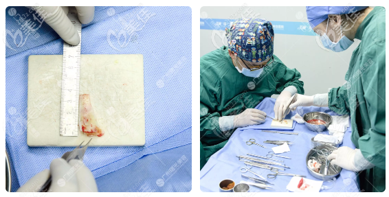 廣州曙光王旭明鼻修復(fù)過程圖 廣州曙光王旭明鼻修復(fù)過程圖