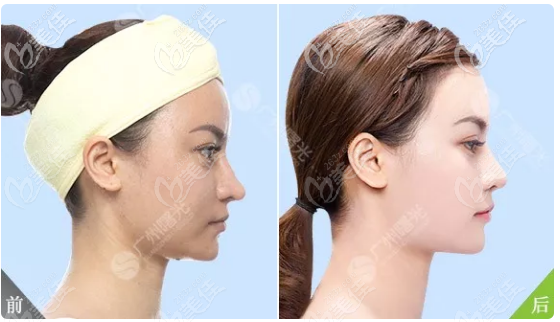 廣州曙光王旭明鼻綜合隆鼻子案例 廣州曙光王旭明鼻綜合隆鼻子案例