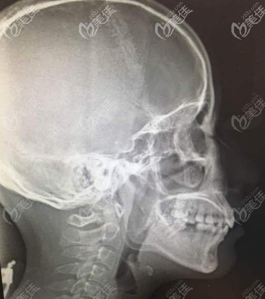 2級骨性齙牙的頭顱片