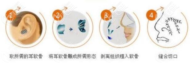 耳軟骨隆鼻的原理